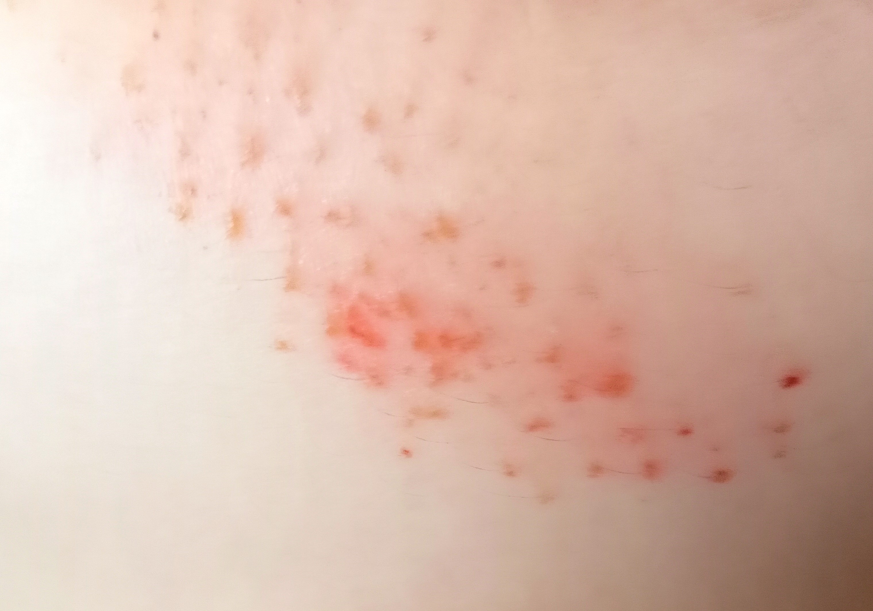 湿疹ができた肌