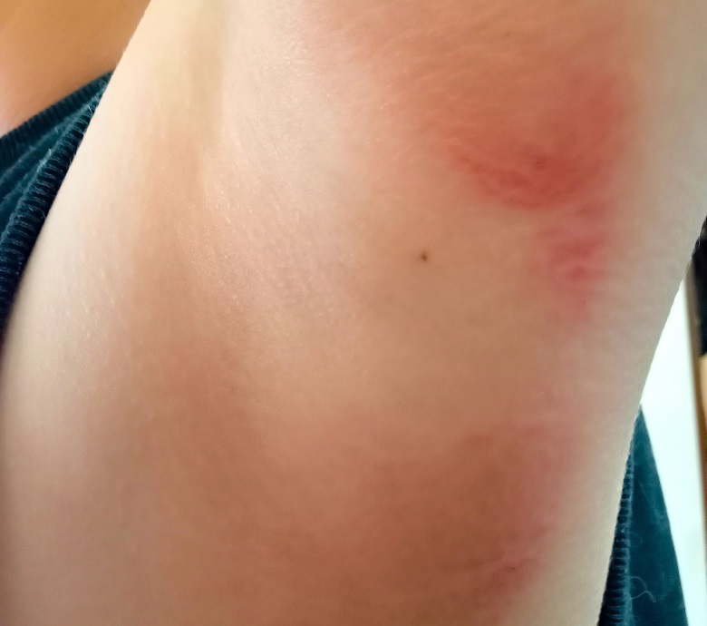 ただれて赤くなっている脇の下